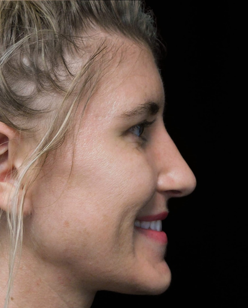 Beverly Hills Rhinoplasty Before & After Gallery - Patient 109427 - Image 9 Dr. Deepak Raj Dugar