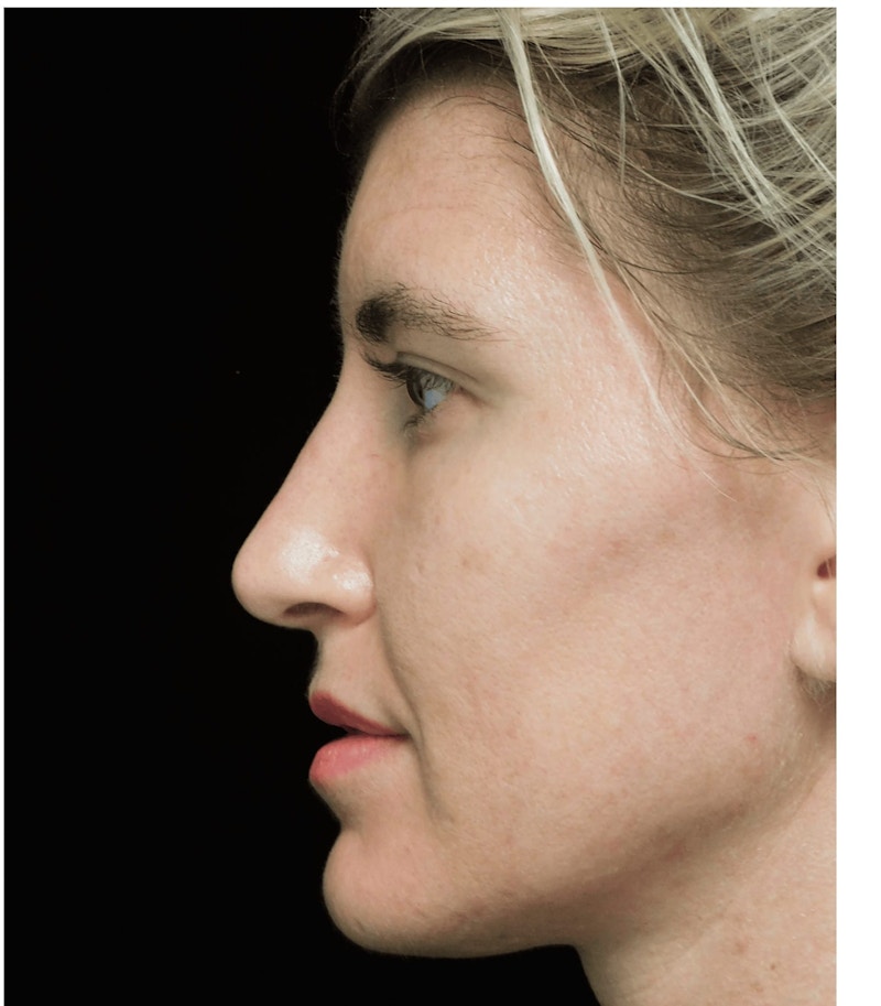 Beverly Hills Rhinoplasty Before & After Gallery - Patient 109427 - Image 11 Dr. Deepak Raj Dugar