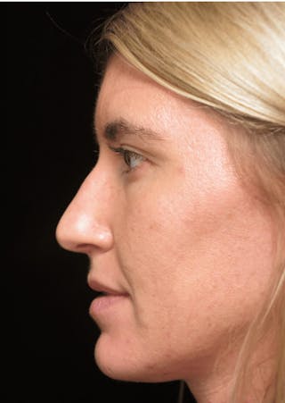 Beverly Hills Rhinoplasty Before & After Gallery - Patient 109427 - Image 12 Dr. Deepak Raj Dugar