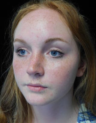 Beverly Hills Rhinoplasty Before & After Gallery - Patient 504445 - Image 10 Dr. Deepak Raj Dugar