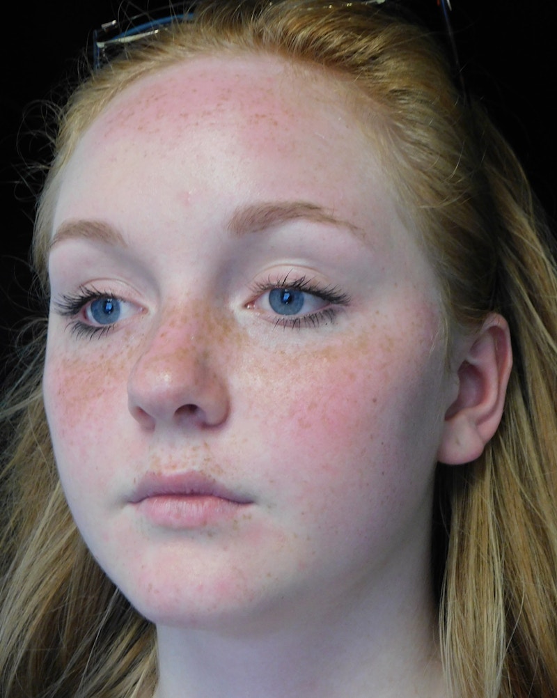Beverly Hills Rhinoplasty Before & After Gallery - Patient 504445 - Image 9 Dr. Deepak Raj Dugar
