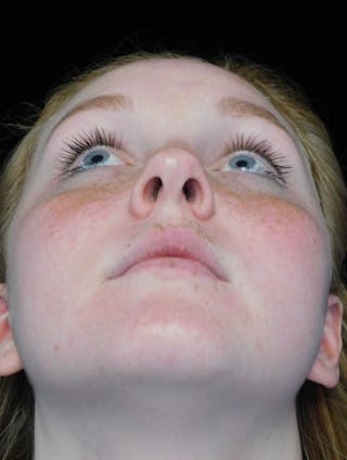 Beverly Hills Rhinoplasty Before & After Gallery - Patient 504445 - Image 8 Dr. Deepak Raj Dugar