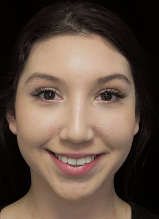 Beverly Hills Rhinoplasty Before & After Gallery - Patient 143168 - Image 4 Dr. Deepak Raj Dugar