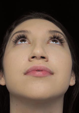 Beverly Hills Rhinoplasty Before & After Gallery - Patient 143168 - Image 6 Dr. Deepak Raj Dugar