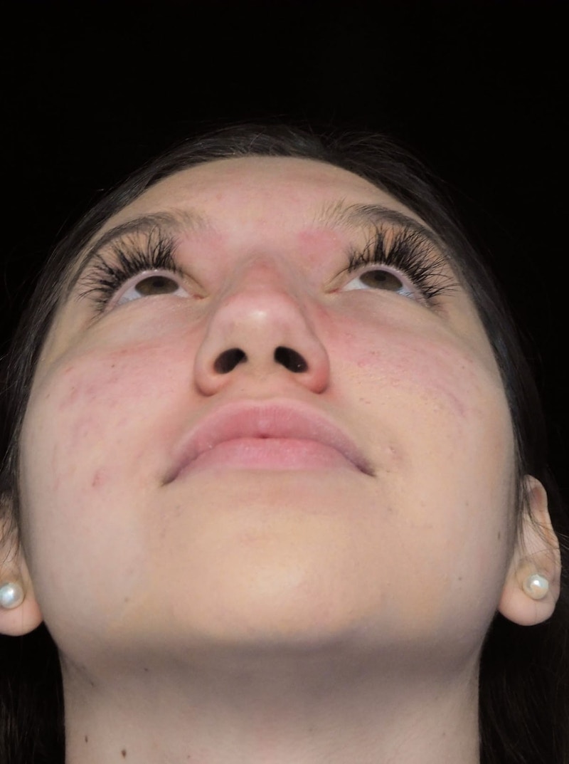 Beverly Hills Rhinoplasty Before & After Gallery - Patient 143168 - Image 5 Dr. Deepak Raj Dugar