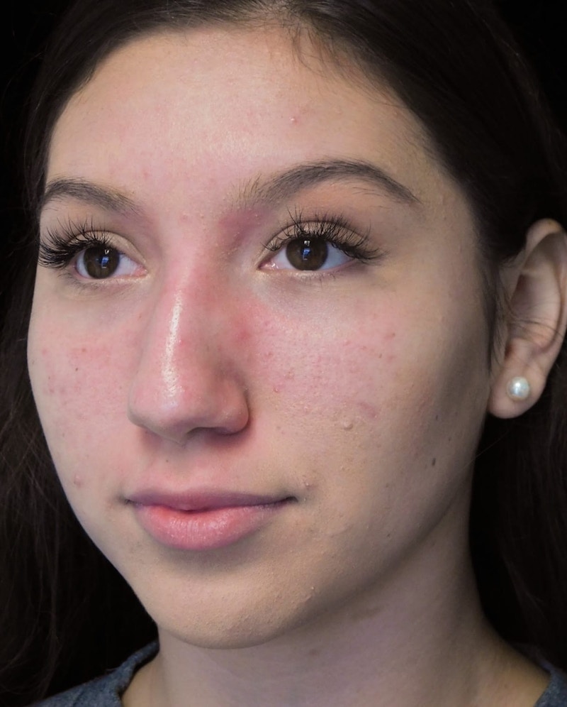 Beverly Hills Rhinoplasty Before & After Gallery - Patient 143168 - Image 7 Dr. Deepak Raj Dugar