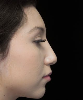 Beverly Hills Rhinoplasty Before & After Gallery - Patient 143168 - Image 2 Dr. Deepak Raj Dugar