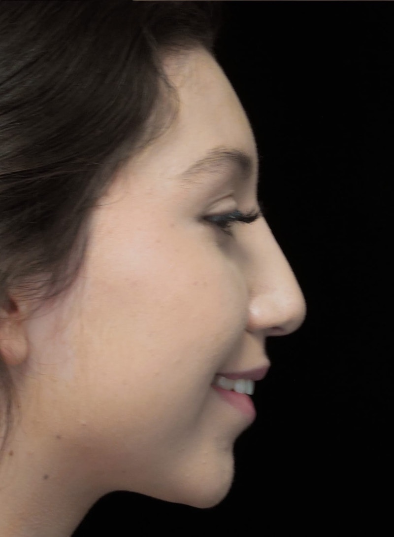 Beverly Hills Rhinoplasty Before & After Gallery - Patient 143168 - Image 10 Dr. Deepak Raj Dugar