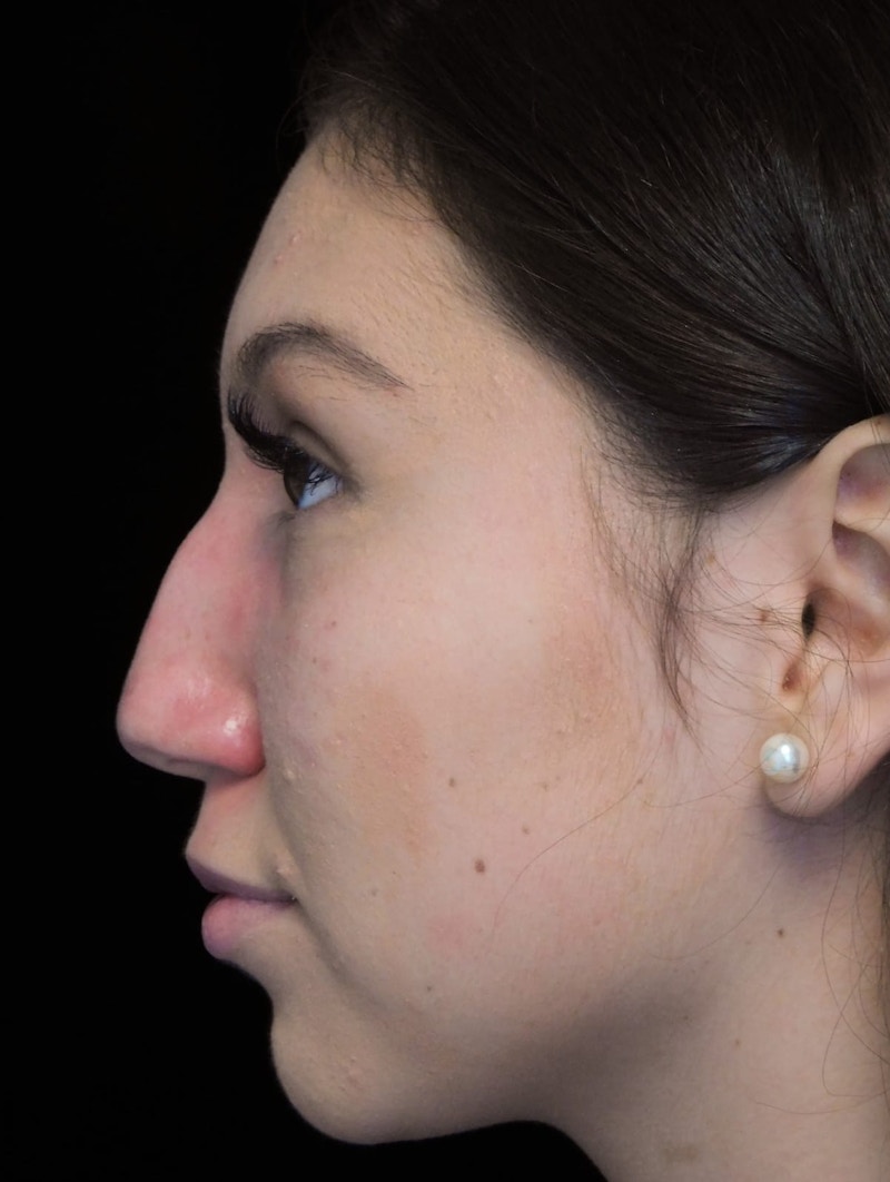Beverly Hills Rhinoplasty Before & After Gallery - Patient 143168 - Image 11 Dr. Deepak Raj Dugar