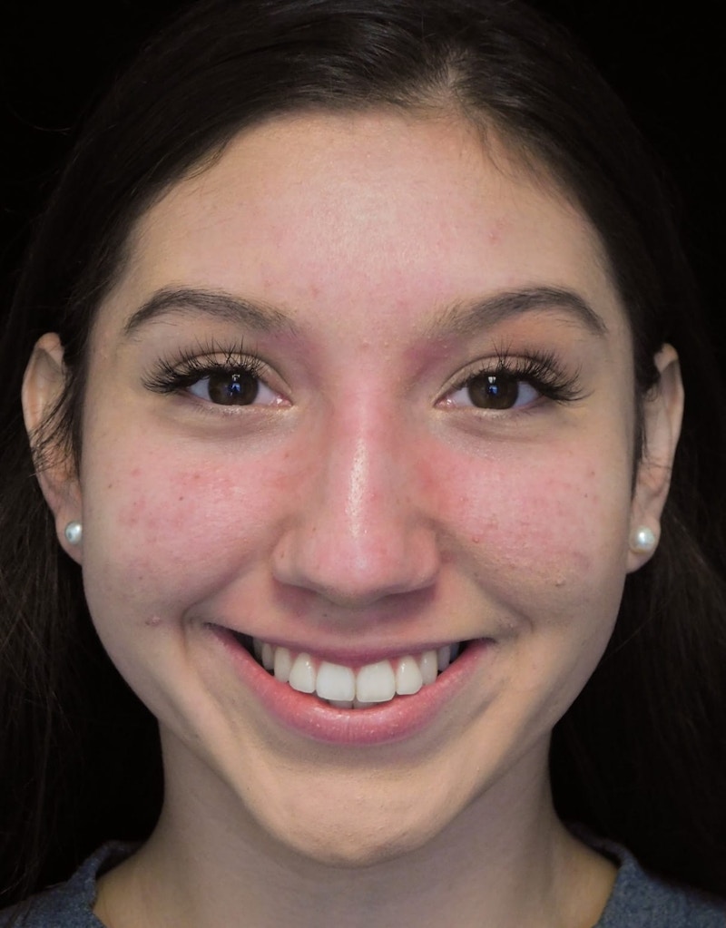Beverly Hills Rhinoplasty Before & After Gallery - Patient 143168 - Image 3 Dr. Deepak Raj Dugar