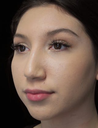 Beverly Hills Rhinoplasty Before & After Gallery - Patient 143168 - Image 8 Dr. Deepak Raj Dugar