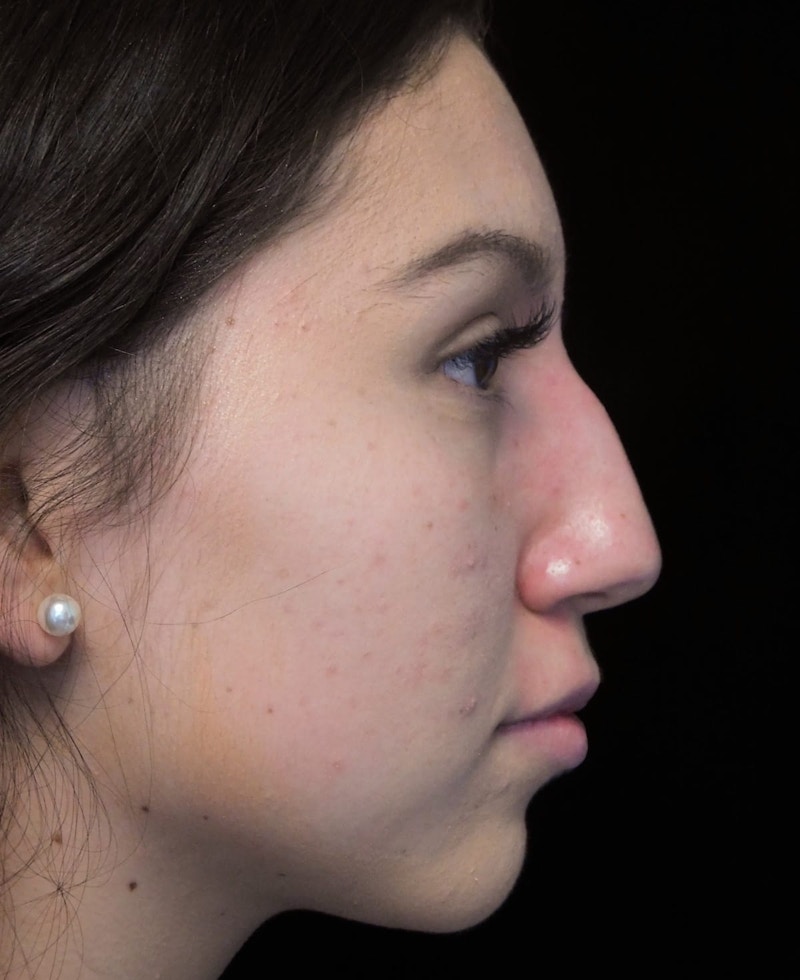 Beverly Hills Rhinoplasty Before & After Gallery - Patient 143168 - Image 1 Dr. Deepak Raj Dugar