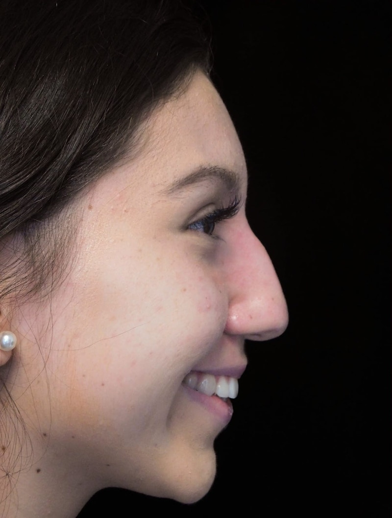 Beverly Hills Rhinoplasty Before & After Gallery - Patient 143168 - Image 9 Dr. Deepak Raj Dugar