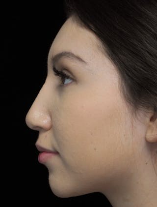 Beverly Hills Rhinoplasty Before & After Gallery - Patient 143168 - Image 12 Dr. Deepak Raj Dugar