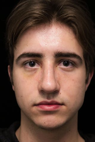 Beverly Hills Rhinoplasty Before & After Gallery - Patient 198423 - Image 4 Dr. Deepak Raj Dugar