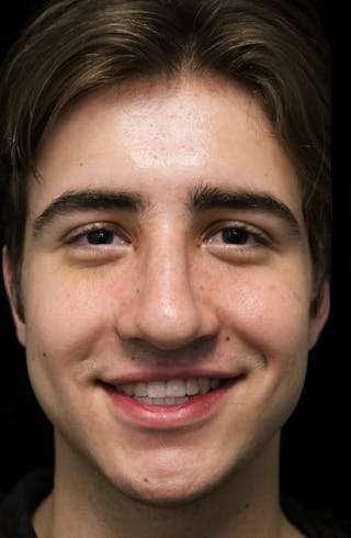 Beverly Hills Rhinoplasty Before & After Gallery - Patient 198423 - Image 6 Dr. Deepak Raj Dugar