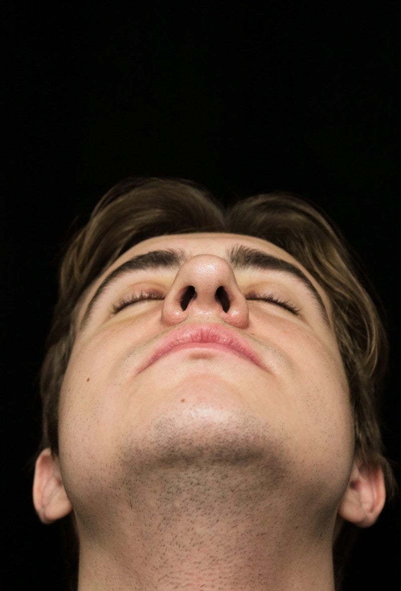 Beverly Hills Rhinoplasty Before & After Gallery - Patient 198423 - Image 8 Dr. Deepak Raj Dugar