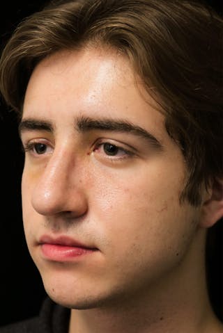 Beverly Hills Rhinoplasty Before & After Gallery - Patient 198423 - Image 10 Dr. Deepak Raj Dugar