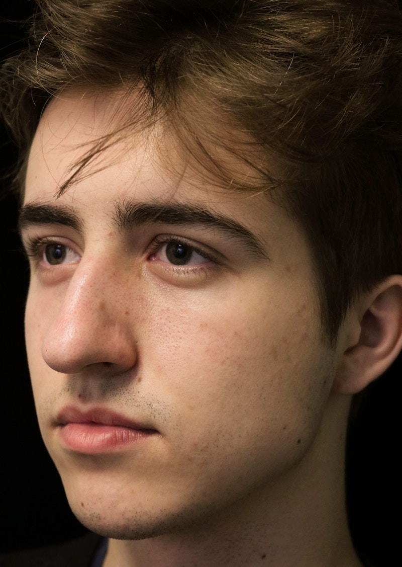 Beverly Hills Rhinoplasty Before & After Gallery - Patient 198423 - Image 9 Dr. Deepak Raj Dugar