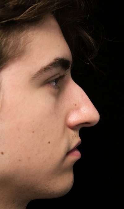 Beverly Hills Rhinoplasty Before & After Gallery - Patient 198423 - Image 1 Dr. Deepak Raj Dugar
