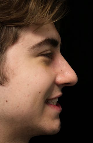 Beverly Hills Rhinoplasty Before & After Gallery - Patient 198423 - Image 12 Dr. Deepak Raj Dugar