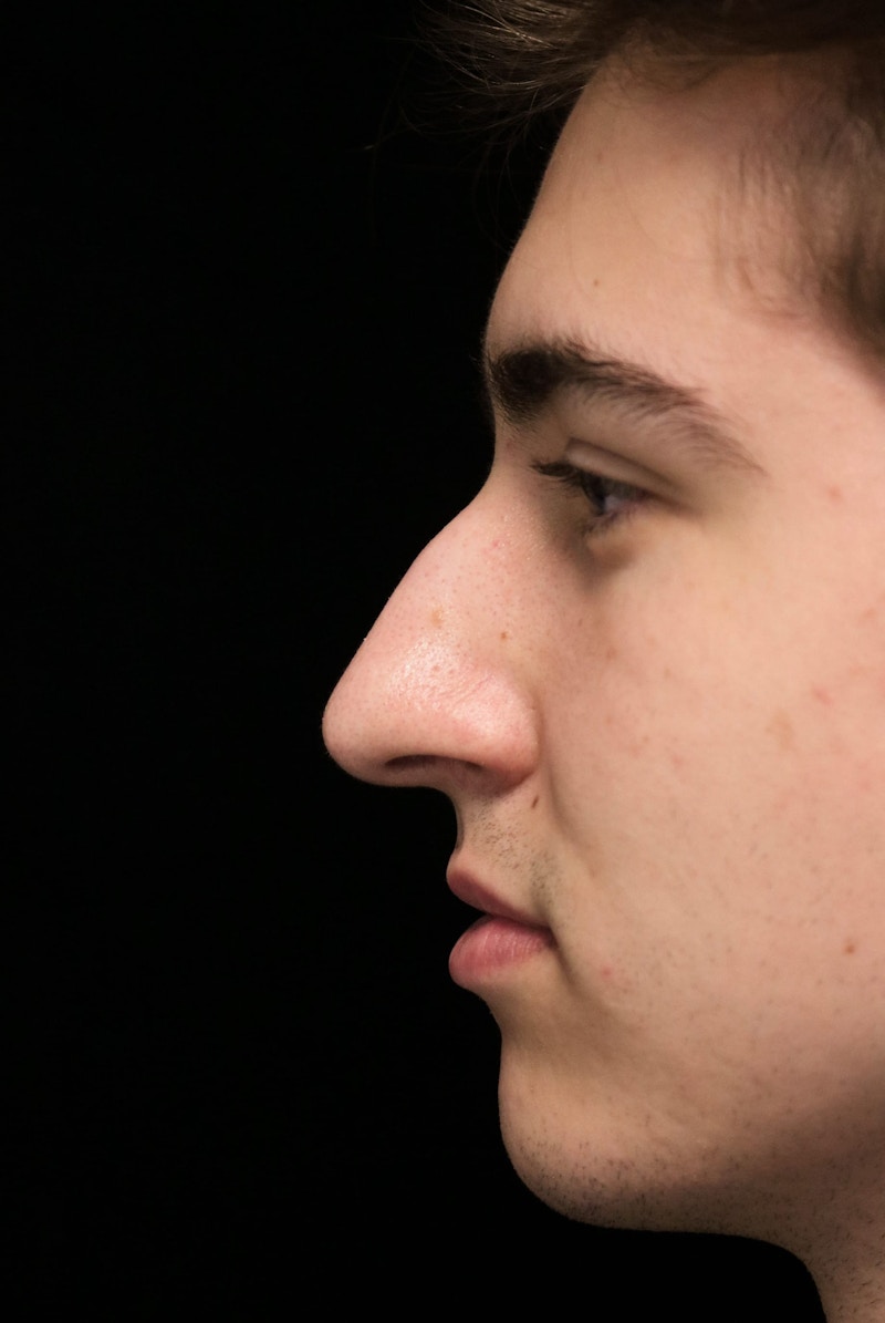 Beverly Hills Rhinoplasty Before & After Gallery - Patient 198423 - Image 13 Dr. Deepak Raj Dugar