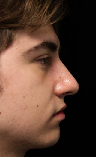 Beverly Hills Rhinoplasty Before & After Gallery - Patient 198423 - Image 2 Dr. Deepak Raj Dugar