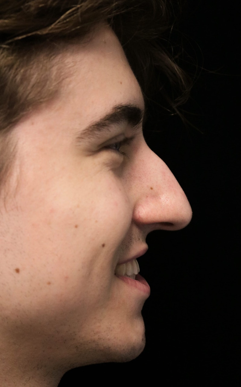 Beverly Hills Rhinoplasty Before & After Gallery - Patient 198423 - Image 11 Dr. Deepak Raj Dugar