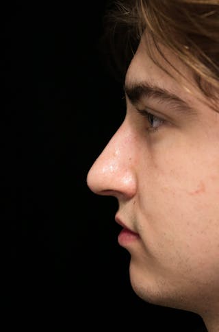 Beverly Hills Rhinoplasty Before & After Gallery - Patient 198423 - Image 14 Dr. Deepak Raj Dugar