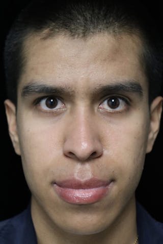 Beverly Hills Rhinoplasty Before & After Gallery - Patient 813730 - Image 4 Dr. Deepak Raj Dugar