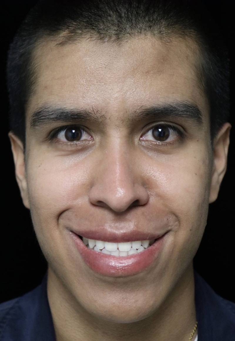 Beverly Hills Rhinoplasty Before & After Gallery - Patient 813730 - Image 5 Dr. Deepak Raj Dugar
