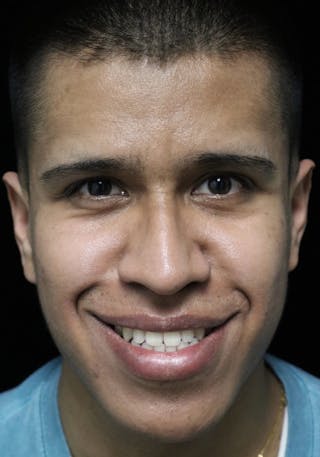 Beverly Hills Rhinoplasty Before & After Gallery - Patient 813730 - Image 6 Dr. Deepak Raj Dugar