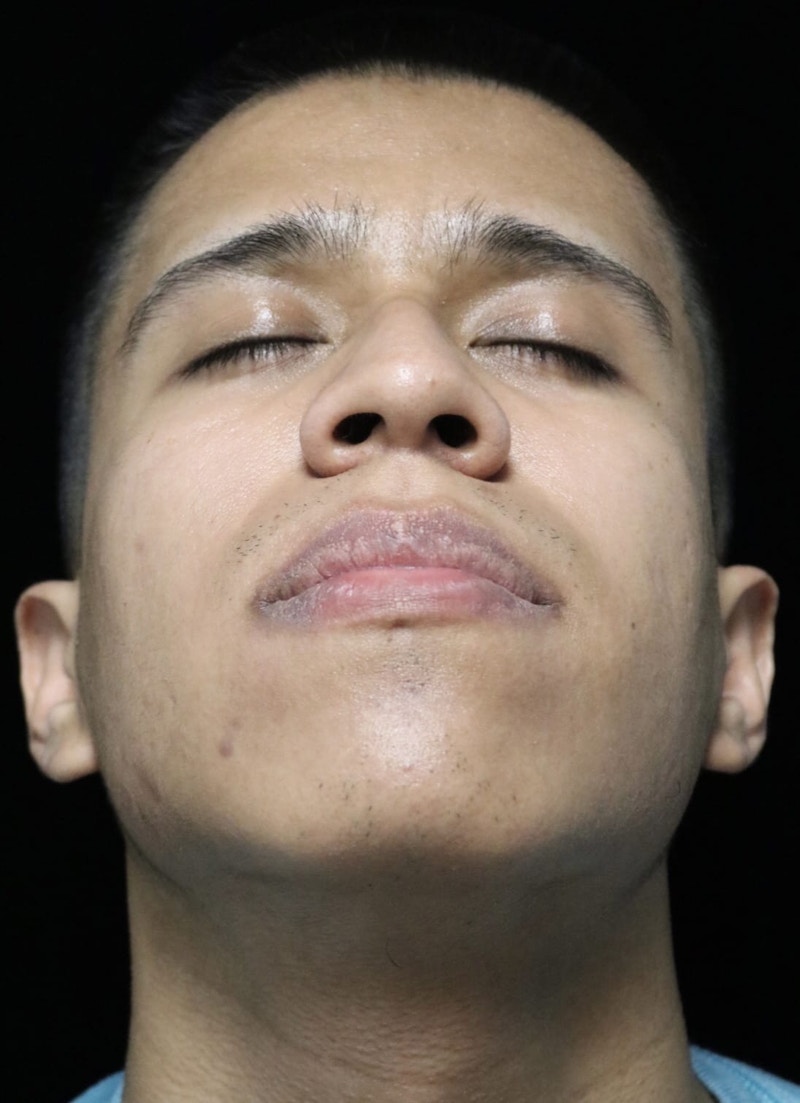 Beverly Hills Rhinoplasty Before & After Gallery - Patient 813730 - Image 7 Dr. Deepak Raj Dugar