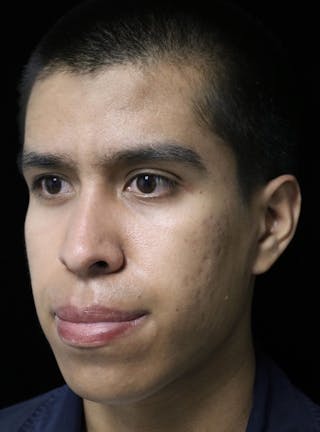 Beverly Hills Rhinoplasty Before & After Gallery - Patient 813730 - Image 10 Dr. Deepak Raj Dugar