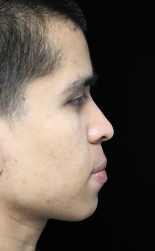 Beverly Hills Rhinoplasty Before & After Gallery - Patient 813730 - Image 2 Dr. Deepak Raj Dugar