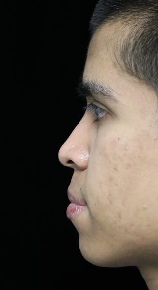 Beverly Hills Rhinoplasty Before & After Gallery - Patient 813730 - Image 14 Dr. Deepak Raj Dugar