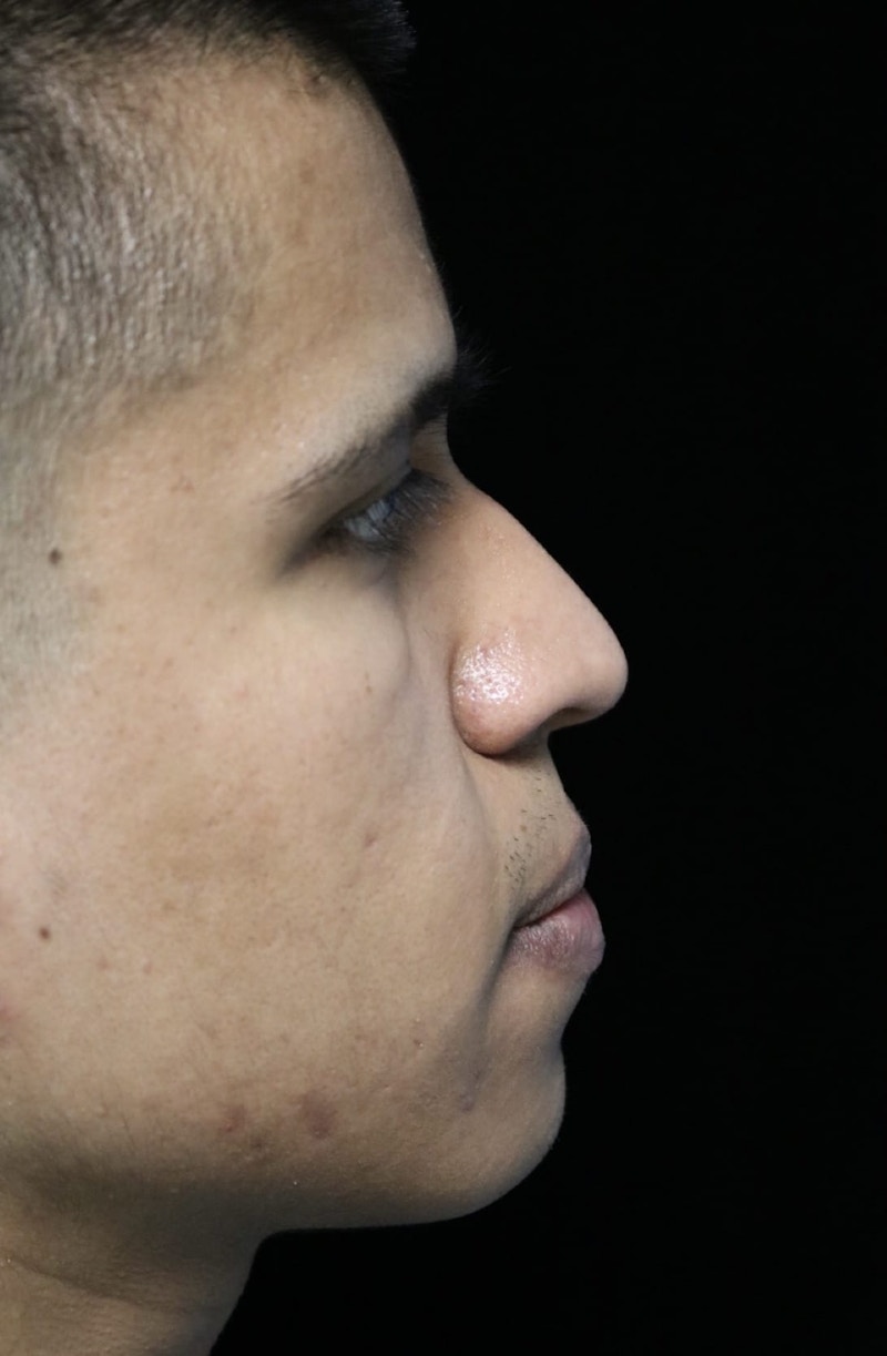 Beverly Hills Rhinoplasty Before & After Gallery - Patient 813730 - Image 1 Dr. Deepak Raj Dugar