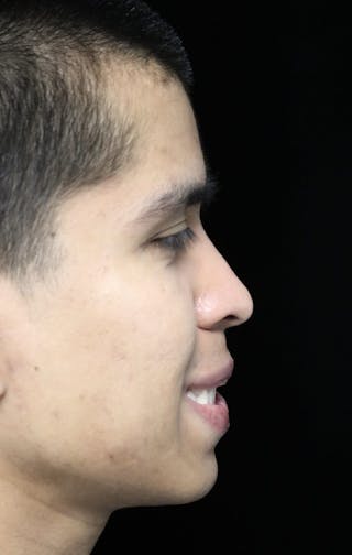 Beverly Hills Rhinoplasty Before & After Gallery - Patient 813730 - Image 12 Dr. Deepak Raj Dugar