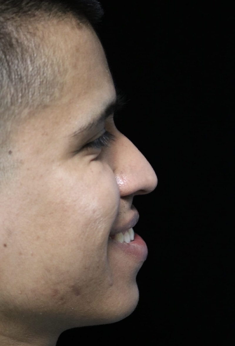 Beverly Hills Rhinoplasty Before & After Gallery - Patient 813730 - Image 11 Dr. Deepak Raj Dugar