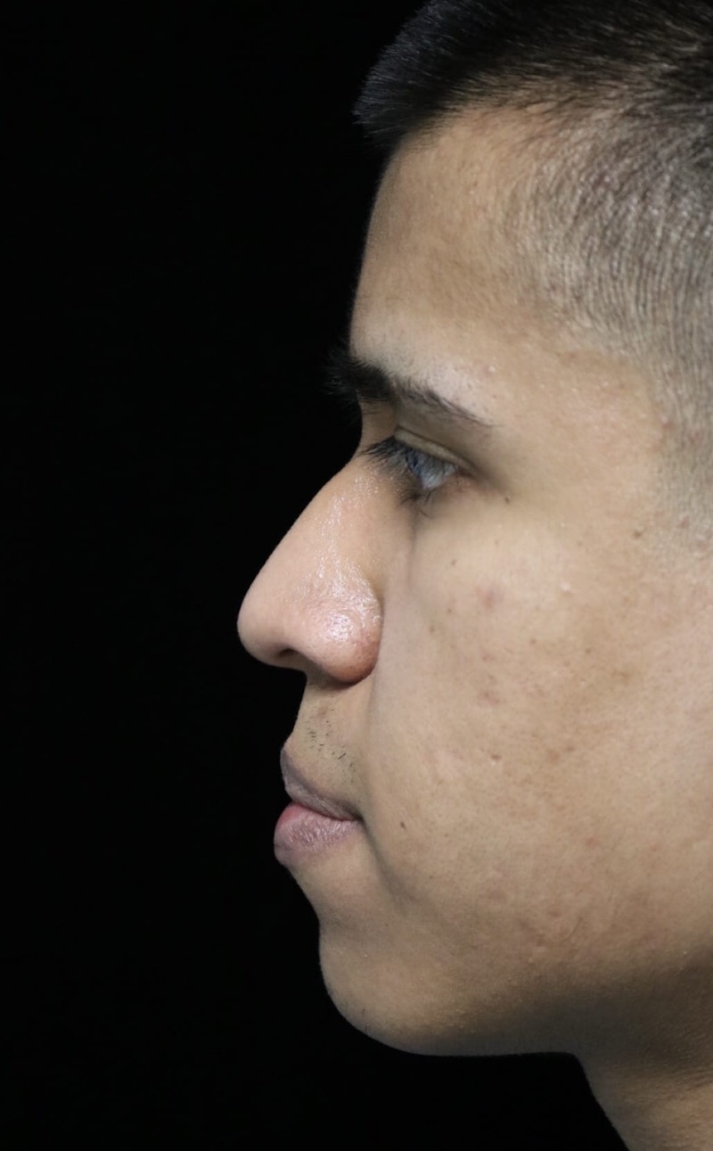 Beverly Hills Rhinoplasty Before & After Gallery - Patient 813730 - Image 13 Dr. Deepak Raj Dugar