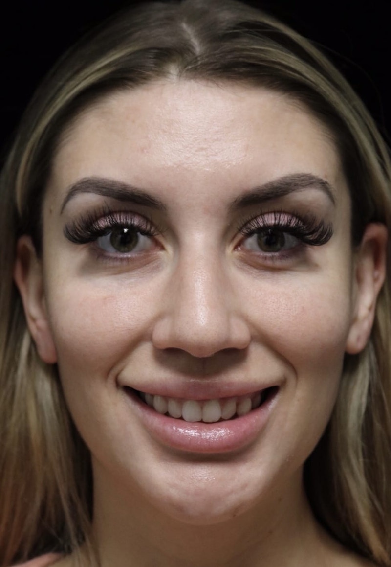 Beverly Hills Rhinoplasty Before & After Gallery - Patient 373583 - Image 3 Dr. Deepak Raj Dugar