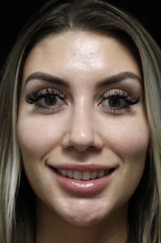 Beverly Hills Rhinoplasty Before & After Gallery - Patient 373583 - Image 4 Dr. Deepak Raj Dugar