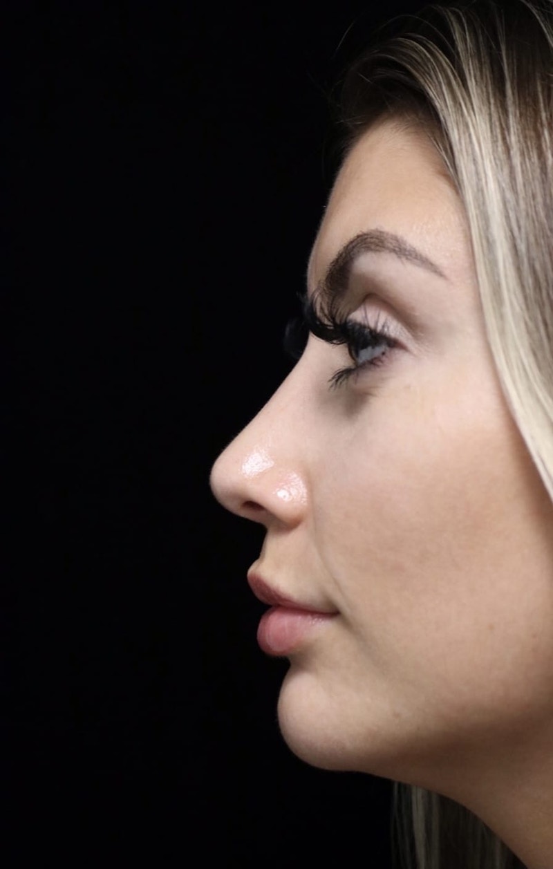 Beverly Hills Rhinoplasty Before & After Gallery - Patient 373583 - Image 6 Dr. Deepak Raj Dugar