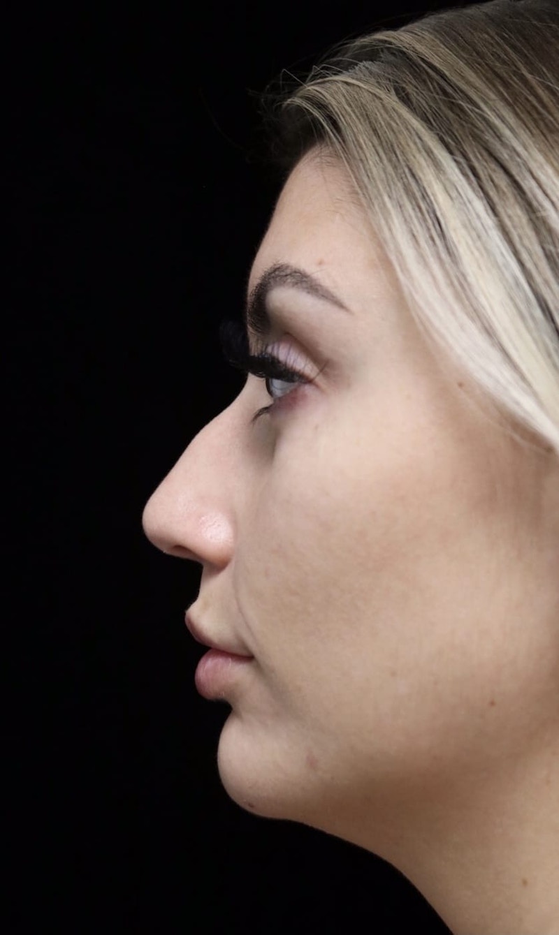 Beverly Hills Rhinoplasty Before & After Gallery - Patient 373583 - Image 5 Dr. Deepak Raj Dugar