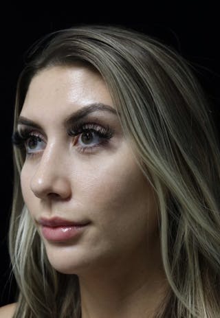 Beverly Hills Rhinoplasty Before & After Gallery - Patient 373583 - Image 10 Dr. Deepak Raj Dugar