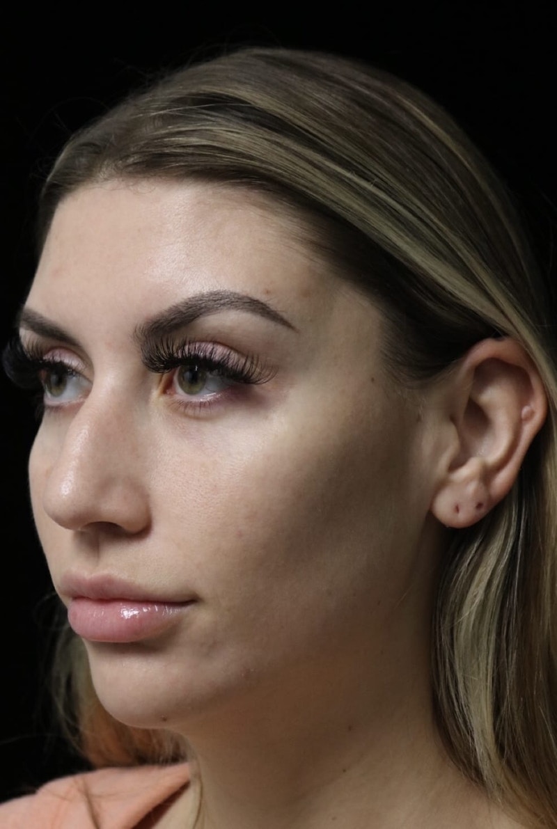 Beverly Hills Rhinoplasty Before & After Gallery - Patient 373583 - Image 9 Dr. Deepak Raj Dugar