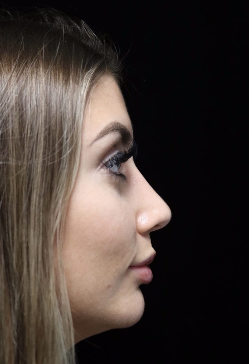Beverly Hills Rhinoplasty Before & After Gallery - Patient 373583 - Image 2 Dr. Deepak Raj Dugar