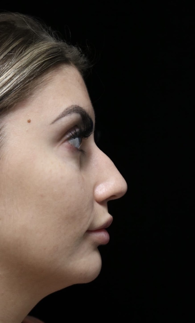 Beverly Hills Rhinoplasty Before & After Gallery - Patient 373583 - Image 1 Dr. Deepak Raj Dugar