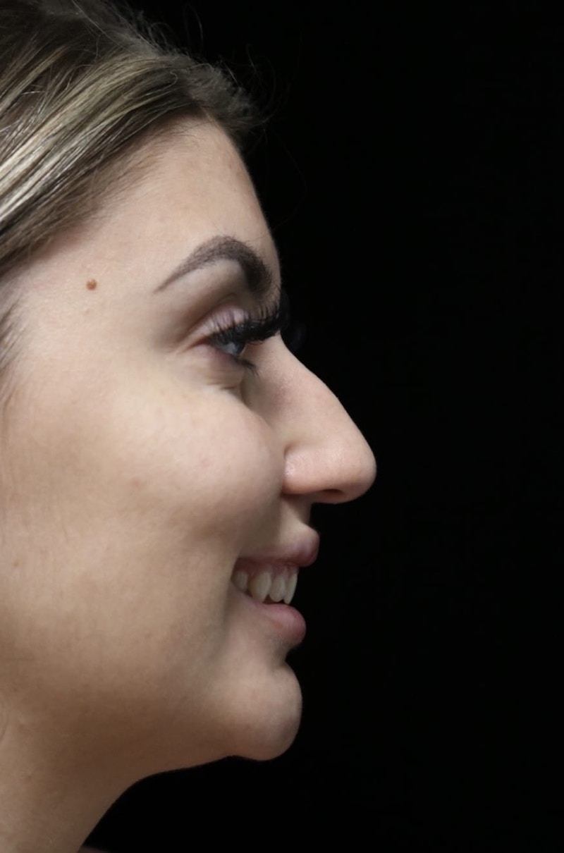 Beverly Hills Rhinoplasty Before & After Gallery - Patient 373583 - Image 11 Dr. Deepak Raj Dugar