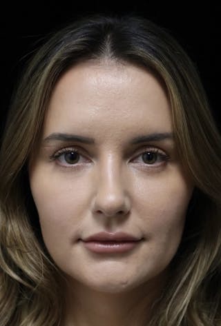 Beverly Hills Rhinoplasty Before & After Gallery - Patient 141036 - Image 4 Dr. Deepak Raj Dugar